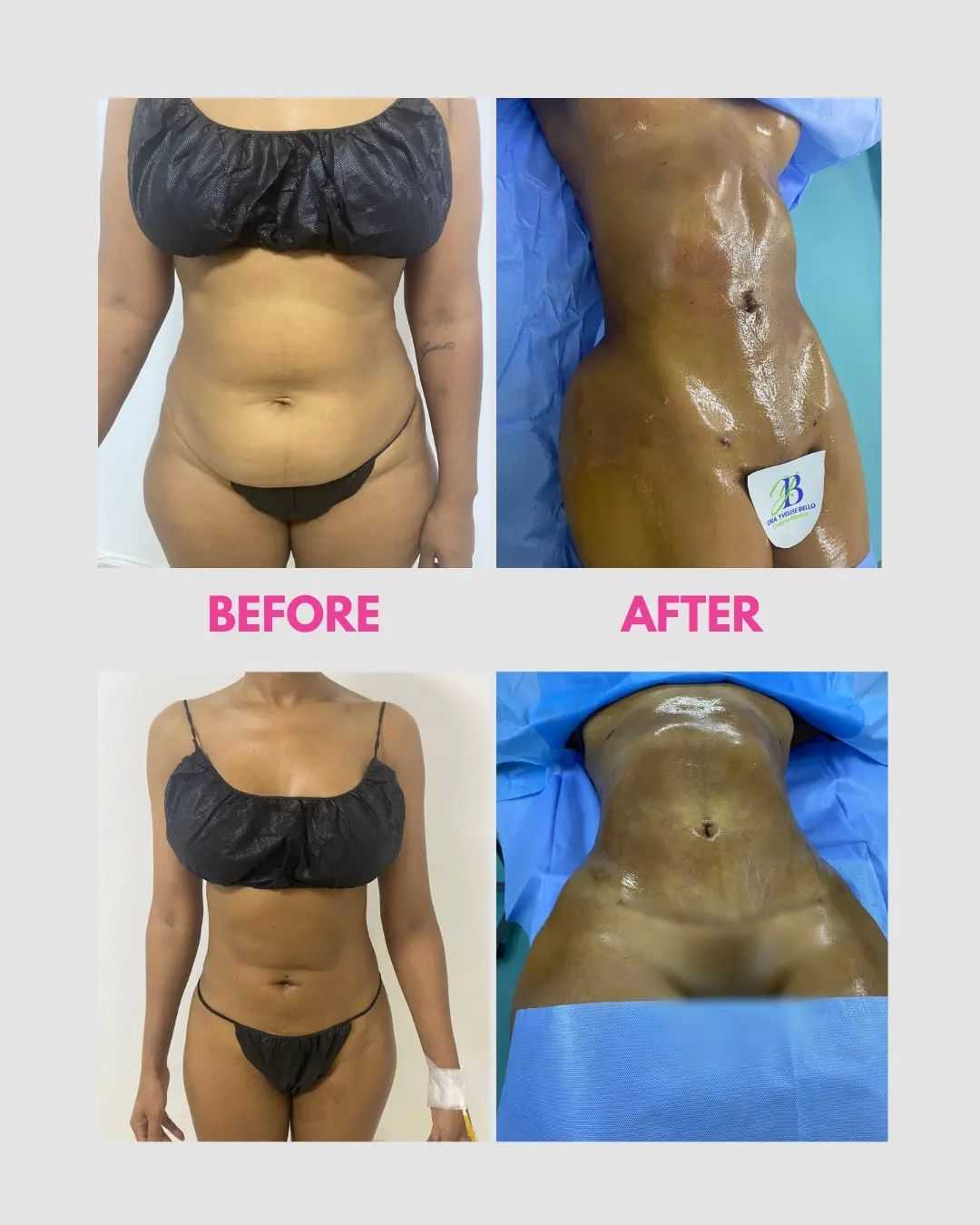 Liposuction in Santo Domingo, Dominican Republic Before After Images by El Vergel
