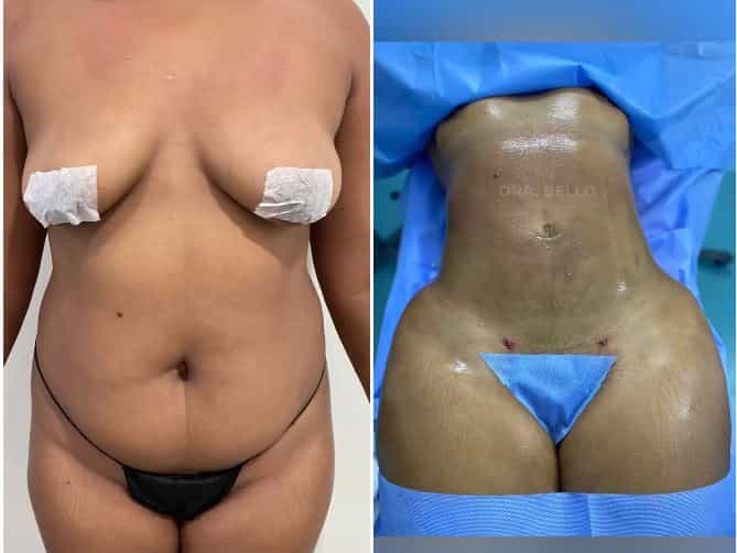 Liposuction in Santo Domingo, Dominican Republic Before After Images by El Vergel Clinic