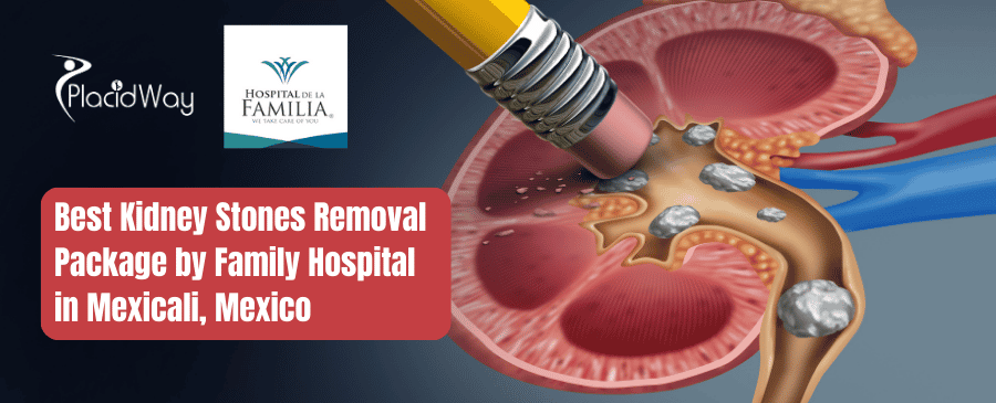 Best Kidney Stones Removal Package by Family Hospital in Mexicali, Mexico