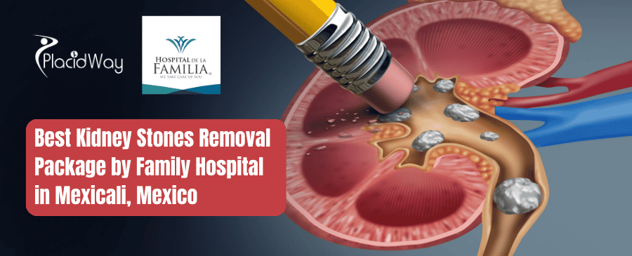 Best Kidney Stones Removal Package by Family Hospital in Mexicali, Mexico