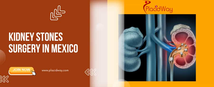 Kidney Stones Surgery Mexico Medical Care