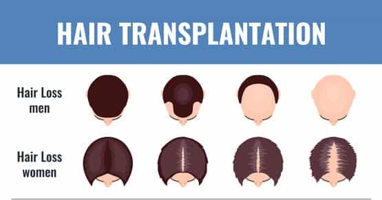 Transplantation of Female Hairline
