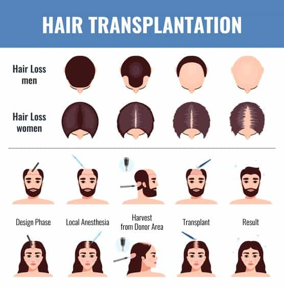 Female Hair Transplant