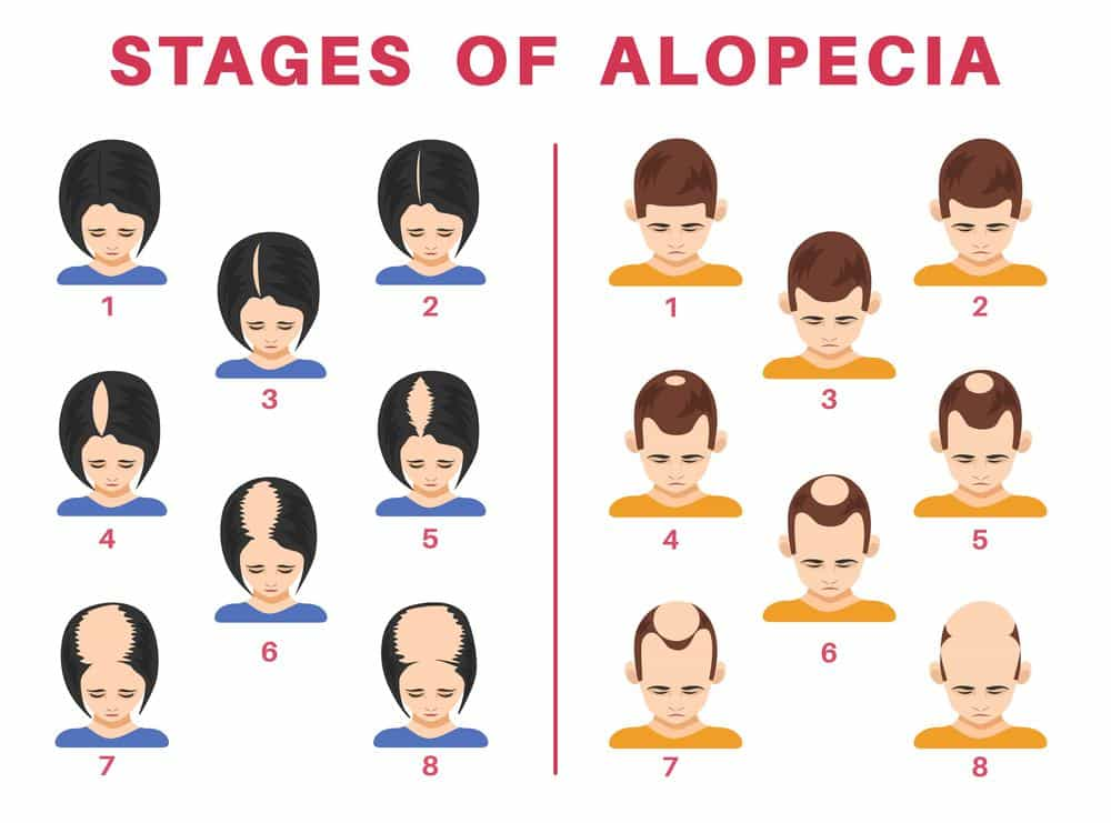 Hair loss in women