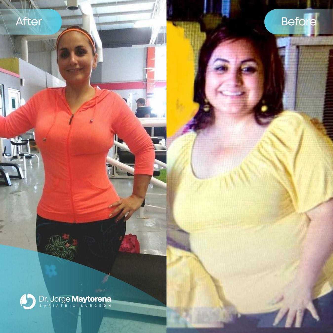 Dr. Jorge Maytorena Gastric Bypass Package in Tijuana, Mexico Before After