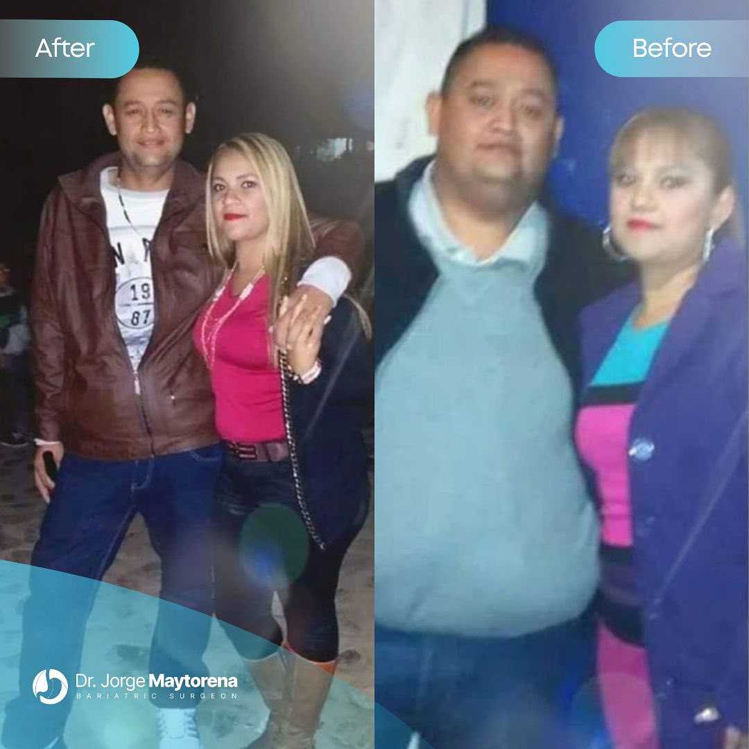 Dr. Jorge Maytorena Gastric Bypass Package in Tijuana, Mexico Before After Image