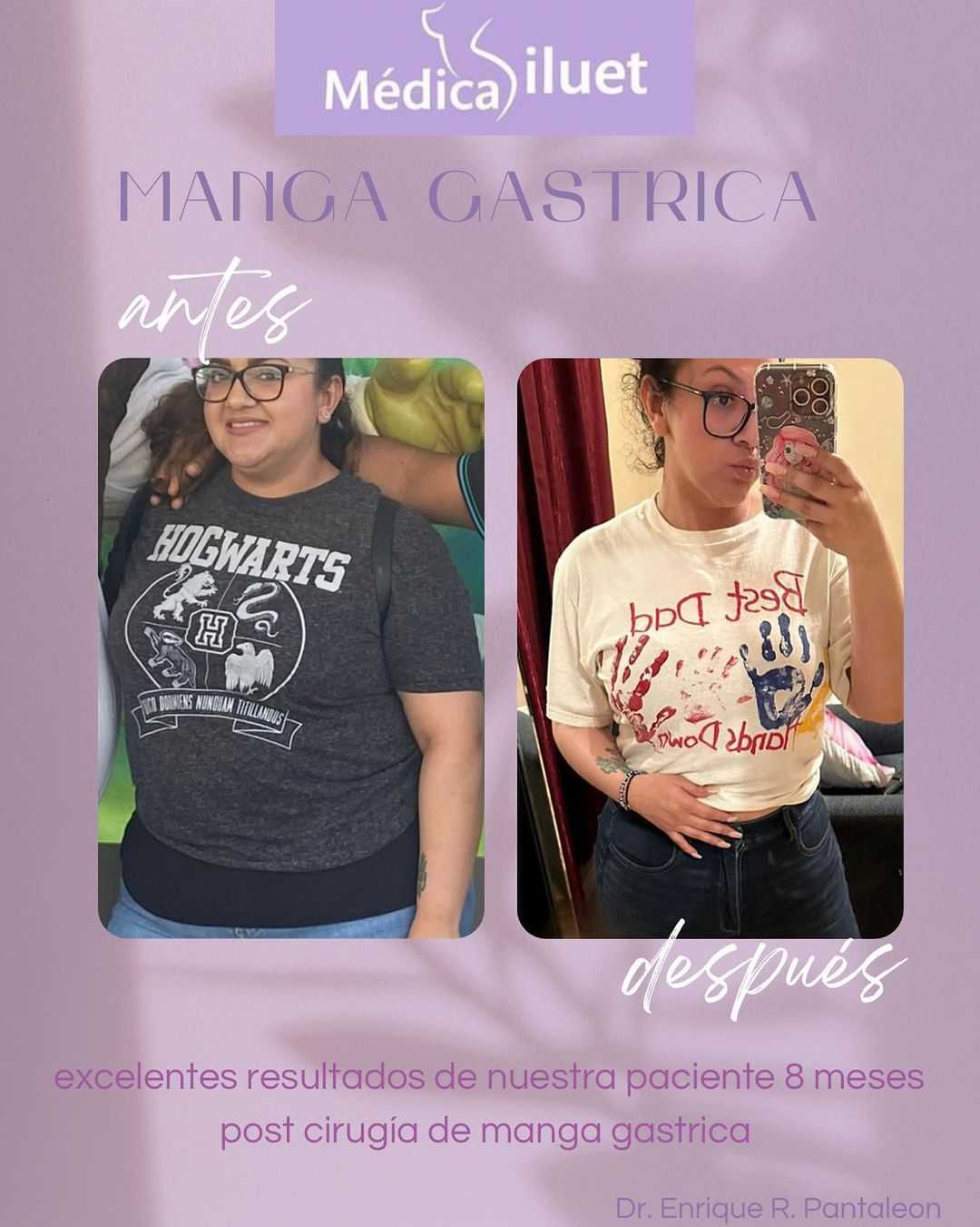 Gastric Bypass Before After in Tijuana Mexico
