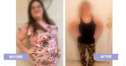 Before and After Images for Gastric Bypass Surgery in Tijuana, Mexico
