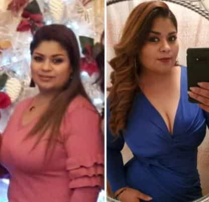 Before and After Results of Gastric Balloon in Mexicali, Mexico