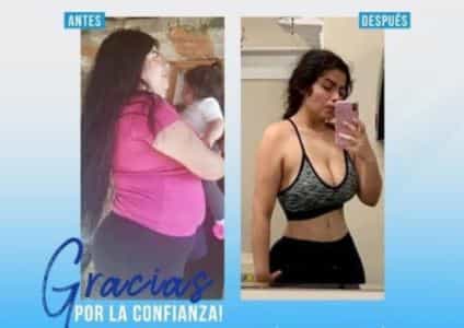 Before and After Results of Gastric Balloon in Mexicali, Mexico