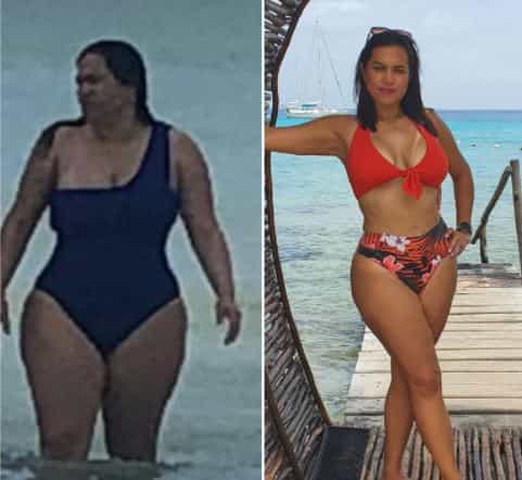 Gastric Sleeve in Cancun, Mexico Before and After Images