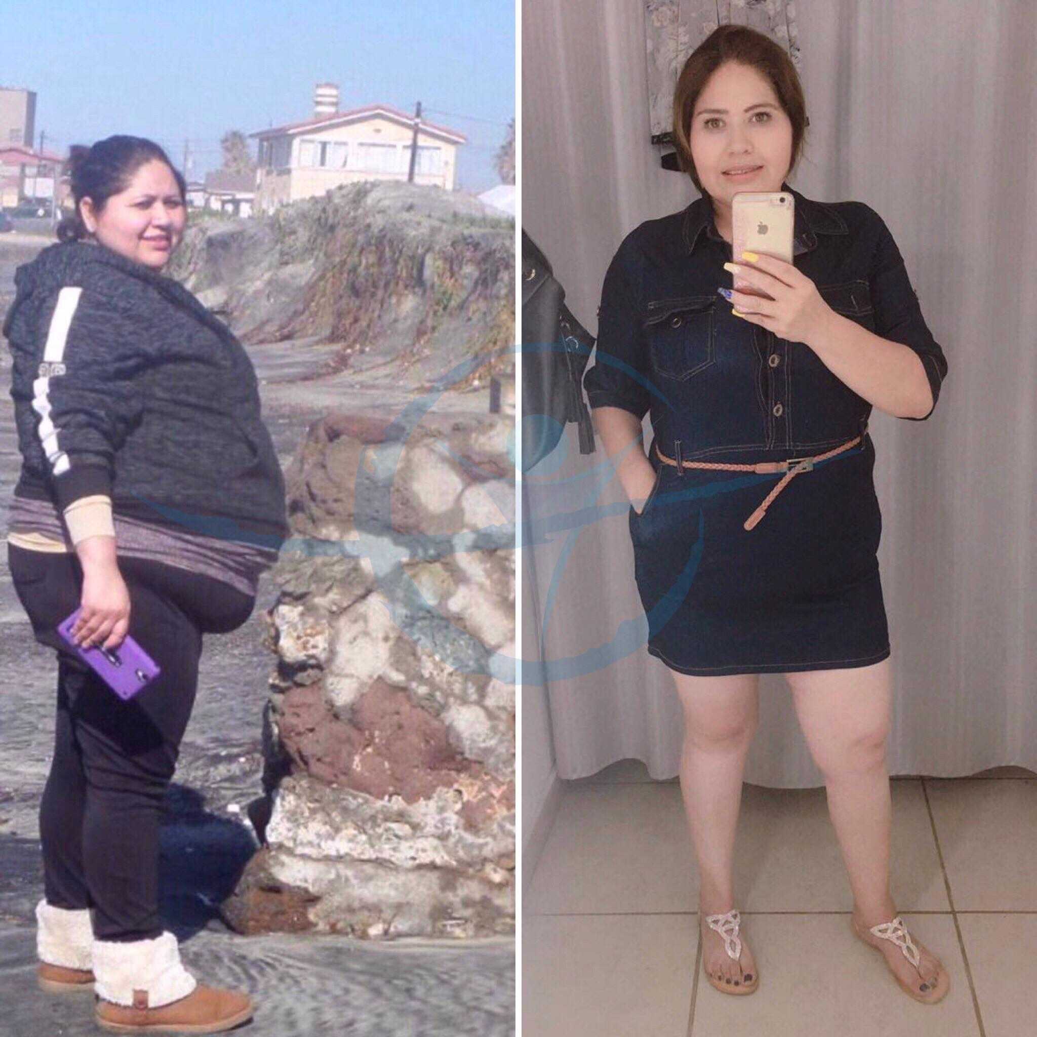 Weight Loss Surgery Mexico