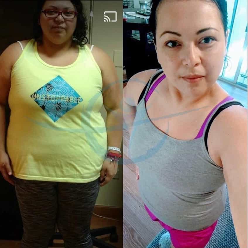 Obesity Surgery In Mexico