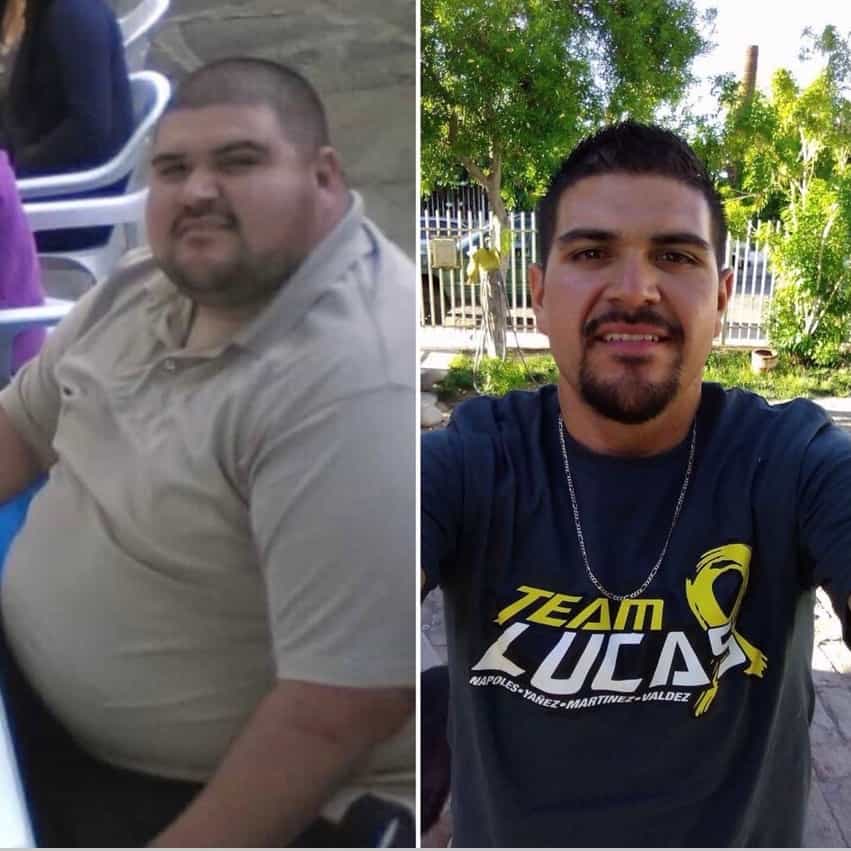 Bariatric Surgery In Mexico