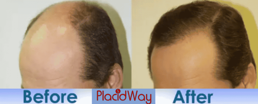 Before and After Images of Hair Transplant in Mexico vs Turkey