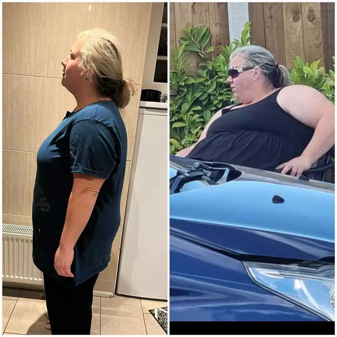 Bariatric Surgery In Turkey