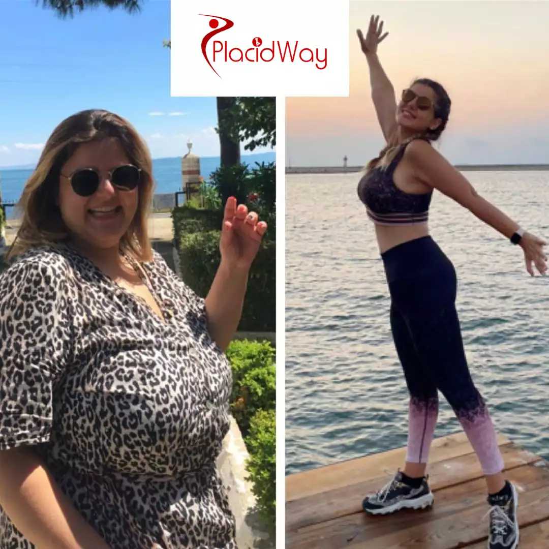 Obesity Surgery In Turkey