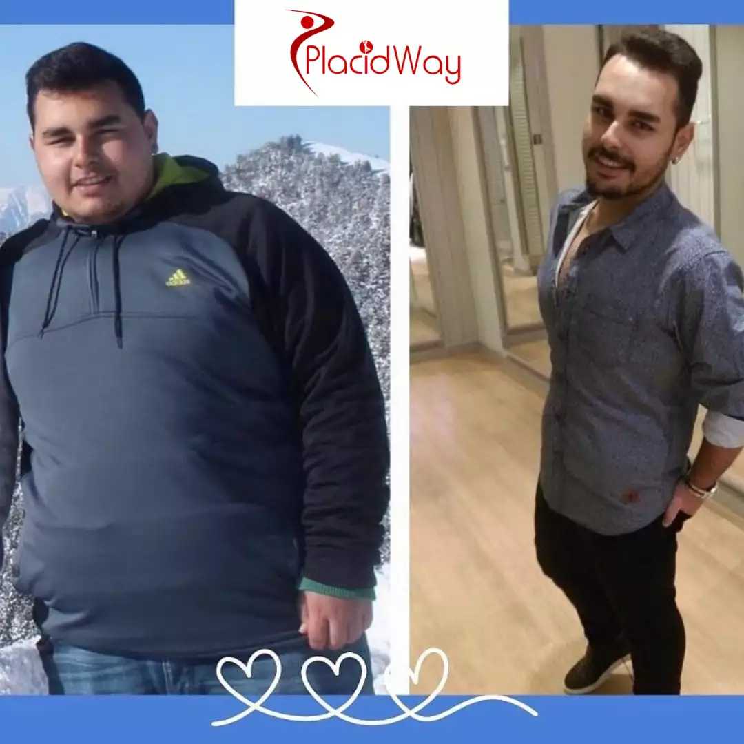 Gastric Sleeve Surgery In Turkey
