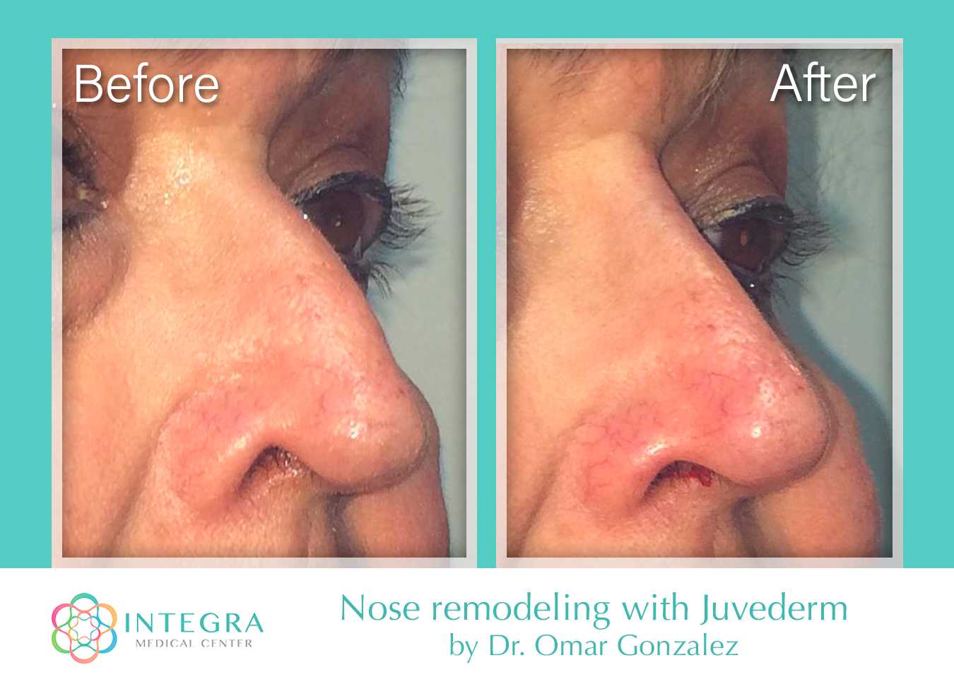 Before After - Nose remodeling with Juvederm. By Dr. Omar Gonzalez at Integra Medical Center in Nuevo Progreso, Mexico.