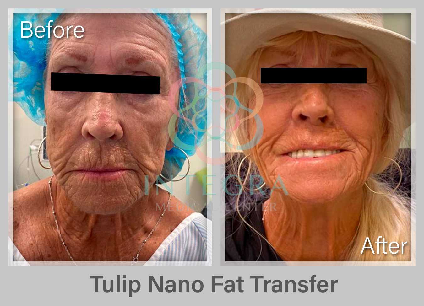 Before After - Tulip Nano Fat Transfer