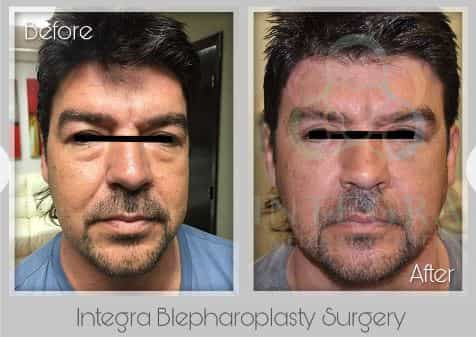 Before After - Integra Blepharoplasty Surgery at Integra Medical Center in Nuevo Progresso Mexico
