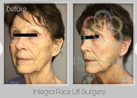 Before After - Integra Facelift Surgery at Integra Medical Center in Nuevo Progresso Mexico
