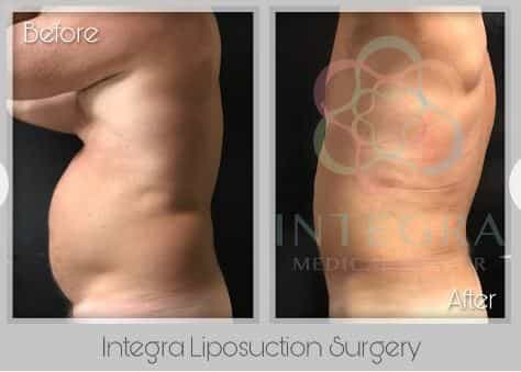 Before After - Integra Liposuction Surgery at Integra Medical Center in Nuevo Progresso Mexico
