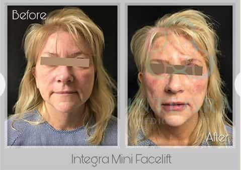 Before After - Integra Mini Facelift at Integra Medical Center in Nuevo Progresso Mexico