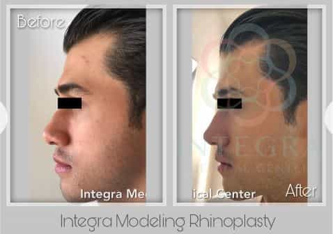 Before After - Integra Modeling Rhinoplasty at Integra Medical Center in Nuevo Progresso Mexico