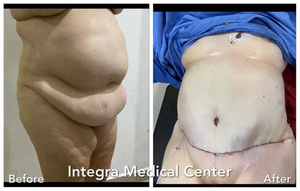 Before After - Tummy Tuck Procedure at Integra Medical Center in Nuevo Progresso Mexico
