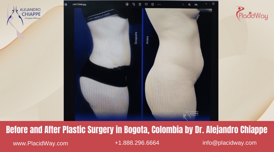 Before After Plastic Surgery in Bogota, Colombia by Dr. Alejandro Chiappe