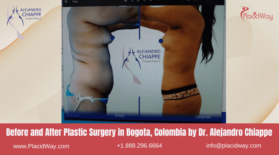 Before After Cosmetic Surgery in Bogota, Colombia by Dr. Alejandro Chiappe