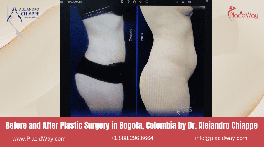 Before and After Plastic Surgery in Bogota, Colombia - Alejandro Chiappe