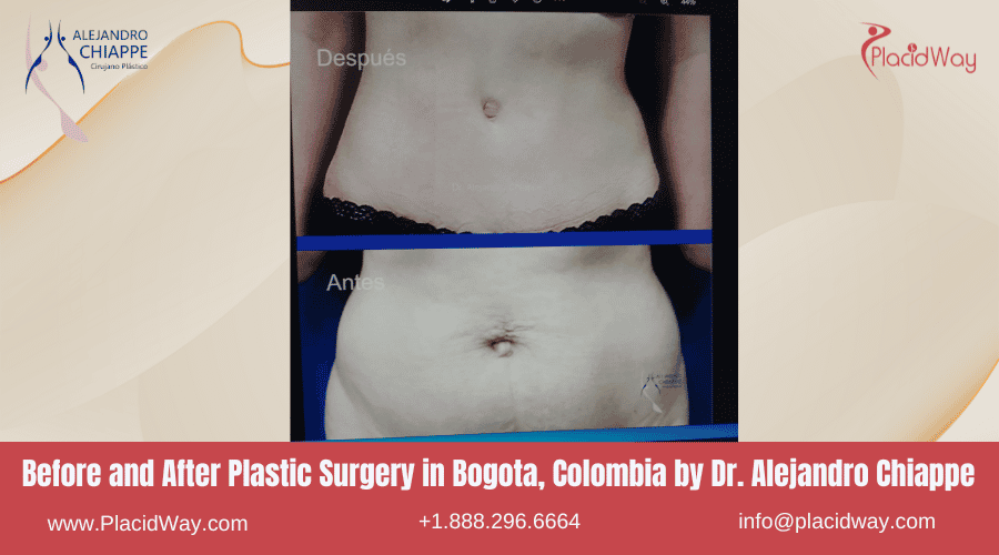 Dr. Alejandro Chiappe Before and After Plastic Surgery in Bogota, Colombia