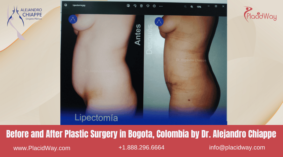 Alejandro Chiappe Before After Plastic Surgery in Bogota, Colombia