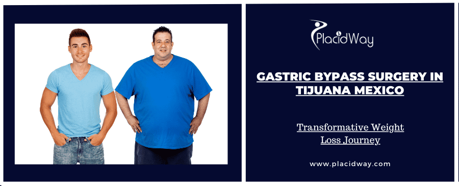 Gastric Bypass Surgery in Tijuana Mexico