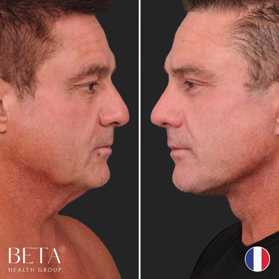 Before After Face Lift in Istanbul, Turkey by Beta Health Group