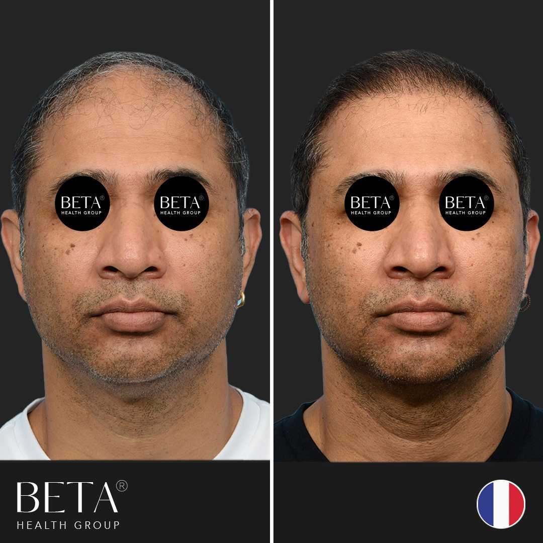 Before After Hair Transplant in Istanbul, Turkey by Beta Health Group