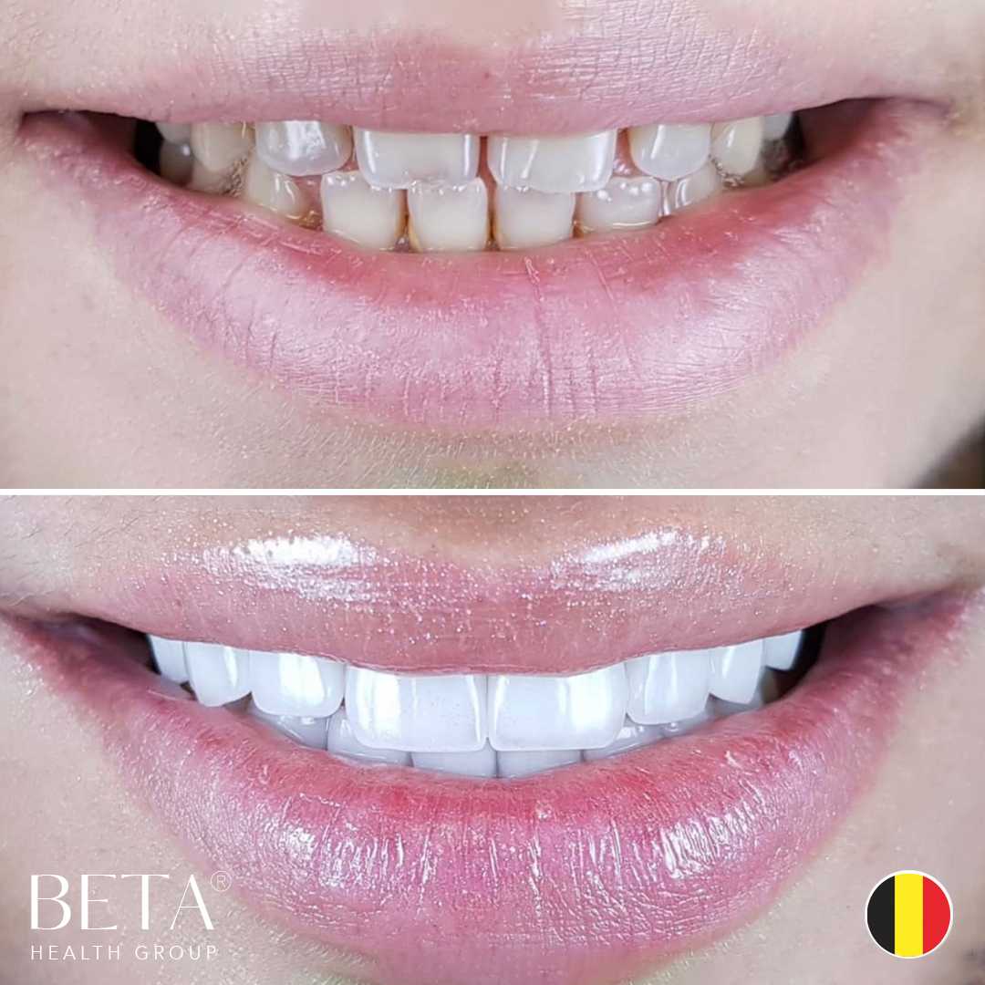 Before After Smile Makeover in Istanbul, Turkey by Beta Health Group