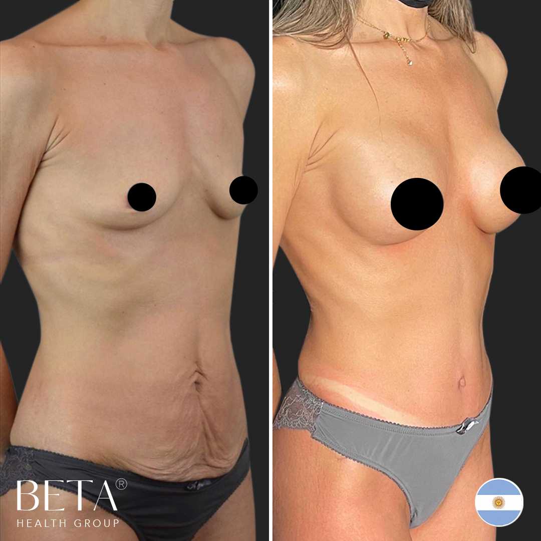 Before After Tummy Tuck and Breast Implant in Istanbul, Turkey by Beta Health Group