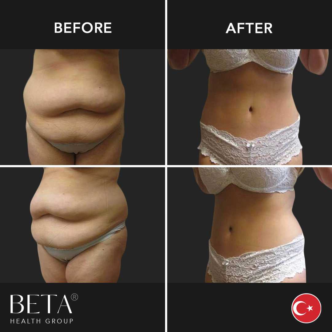 Before After Tummy Tuck and Liposuction in Istanbul, Turkey by Beta Health Group