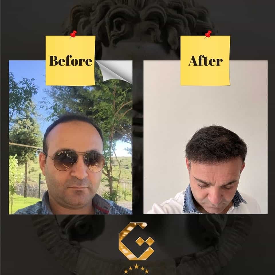 Before and After for Hair Transplantation in Pristina, Kosovo by Gen-O-Time Premium Clinic