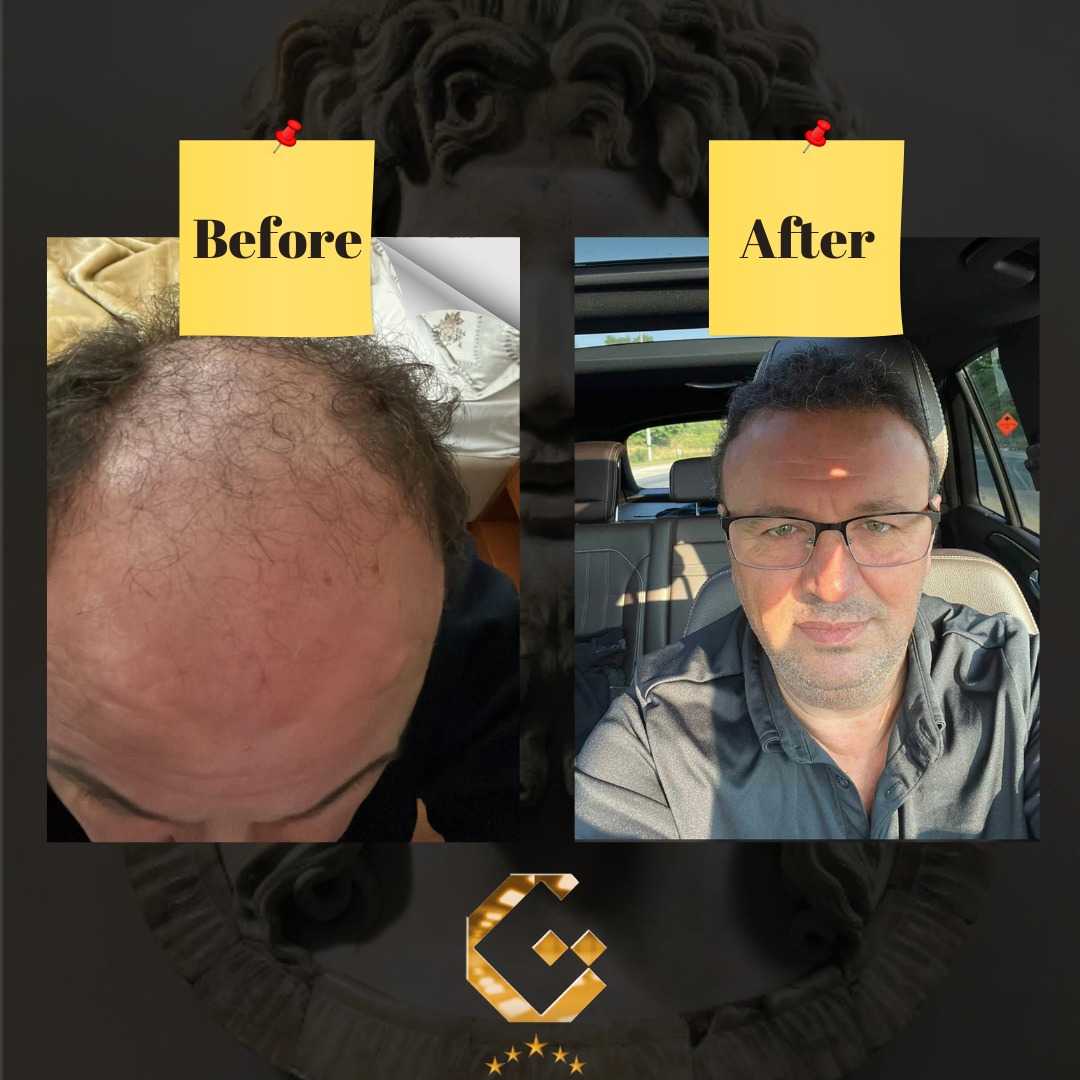 Before and After for Hair Restoration in Pristina, Kosovo by Gen-O-Time Premium Clinic