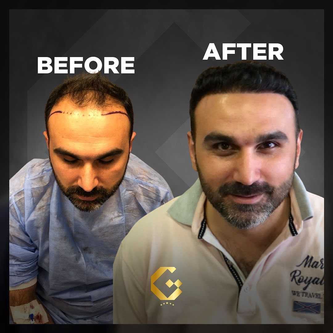 Before After for Hair Transplantation in Pristina, Kosovo by Gen-O-Time Premium Clinic