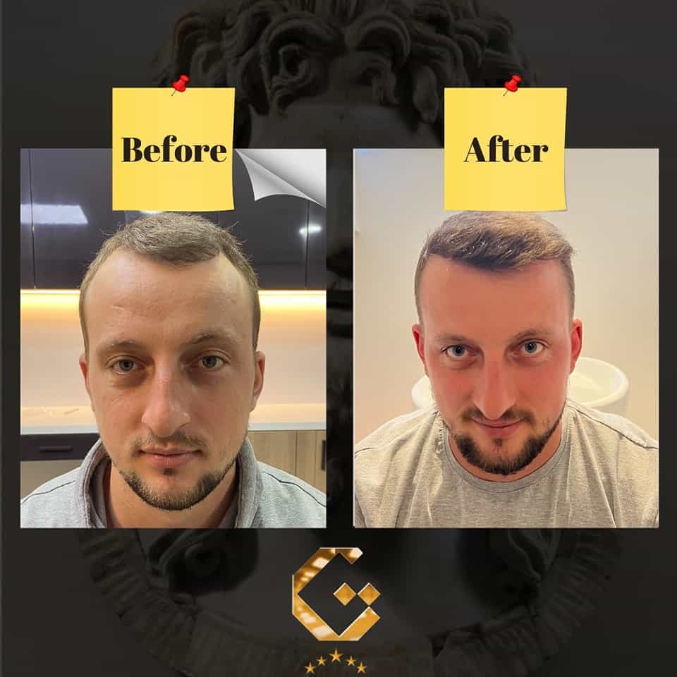 Before After Image for Hair Transplantation in Pristina, Kosovo by Gen-O-Time Premium Clinic