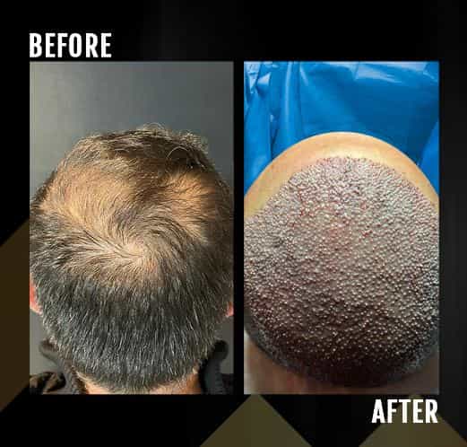 Before After Image Hair Transplant in Tirana Albania by Gen-O-Time Platinum