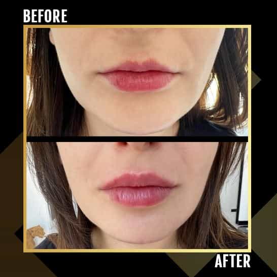 Before After Image Lip Filler in Tirana Albania by Gen-O-Time Platinum