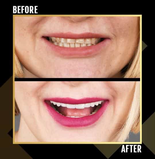 Before After Image Smile Makeover in Tirana Albania by Gen-O-Time Platinum