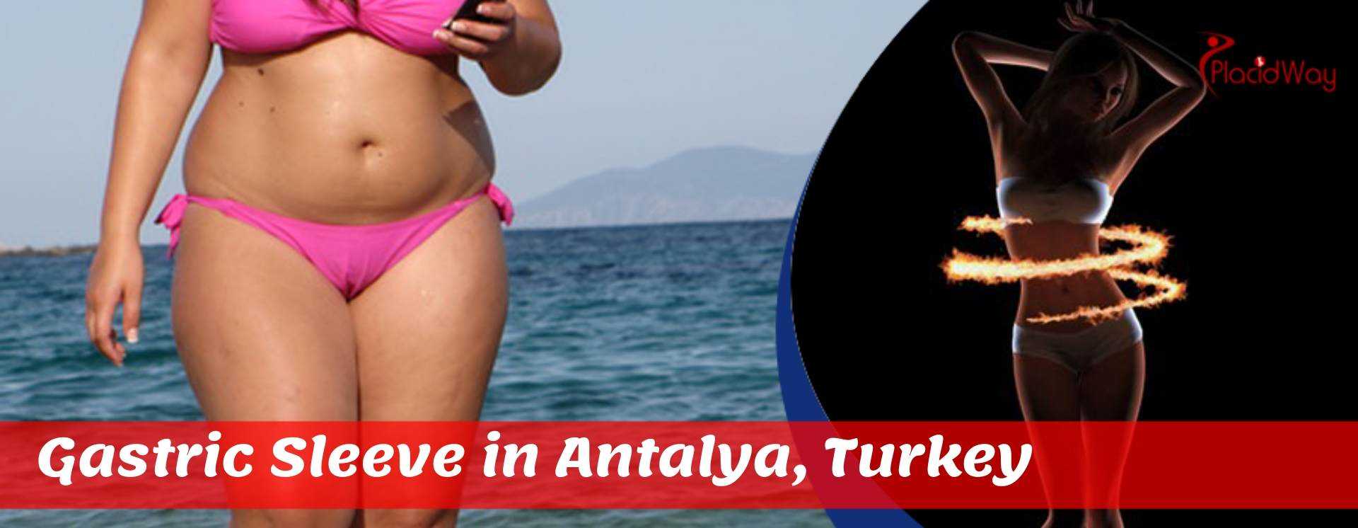 Gastric Sleeve in Antalya, Turkey