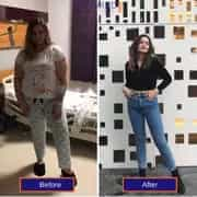 Before and after Gastric SLeeve in Antalya